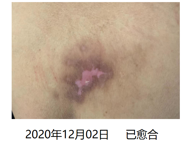 医用泡沫贴怎么用压疮护理不用愁！医用褥疮贴买一送一！_https://www.jmylbn.com_新闻资讯_第10张