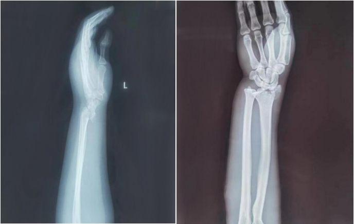 AED怎么自检手腕摔伤后自检方法及诊疗释疑_https://www.jmylbn.com_新闻资讯_第19张