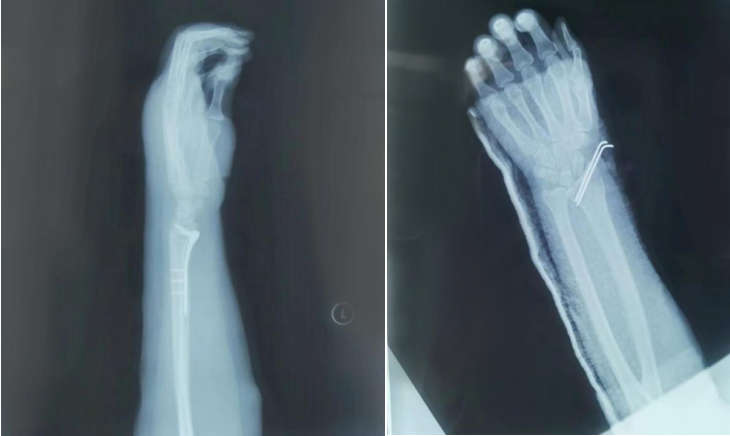 AED怎么自检手腕摔伤后自检方法及诊疗释疑_https://www.jmylbn.com_新闻资讯_第20张