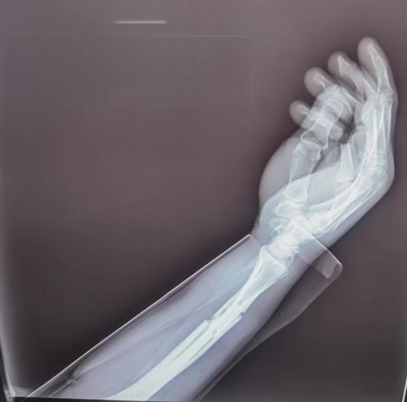 AED怎么自检手腕摔伤后自检方法及诊疗释疑_https://www.jmylbn.com_新闻资讯_第6张