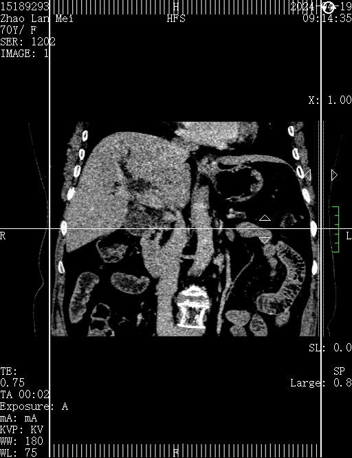 胆管支架什么样子新突破丨无需开刀！市妇幼（市二医院）成功完成院内首例经内镜逆行性胰胆管造影（ERCP）术+覆膜金属支架放置术+胰管支架植入术_https://www.jmylbn.com_新闻资讯_第3张