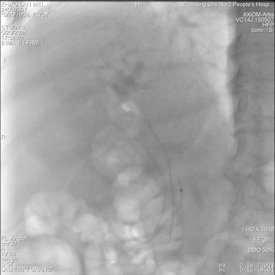 胆管支架什么样子新突破丨无需开刀！市妇幼（市二医院）成功完成院内首例经内镜逆行性胰胆管造影（ERCP）术+覆膜金属支架放置术+胰管支架植入术_https://www.jmylbn.com_新闻资讯_第7张