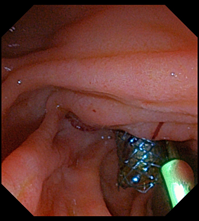 胆管支架什么样子新突破丨无需开刀！市妇幼（市二医院）成功完成院内首例经内镜逆行性胰胆管造影（ERCP）术+覆膜金属支架放置术+胰管支架植入术_https://www.jmylbn.com_新闻资讯_第9张