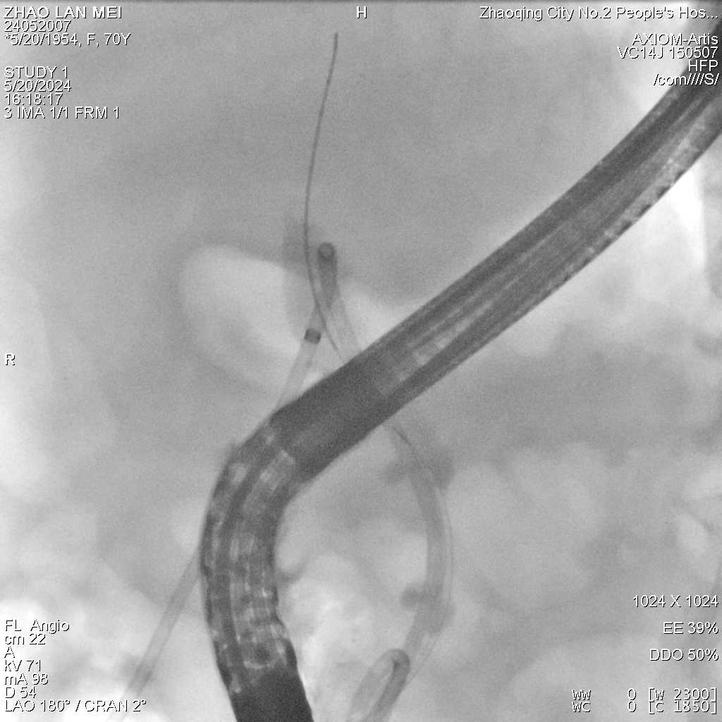 胆管支架什么样子新突破丨无需开刀！市妇幼（市二医院）成功完成院内首例经内镜逆行性胰胆管造影（ERCP）术+覆膜金属支架放置术+胰管支架植入术_https://www.jmylbn.com_新闻资讯_第5张