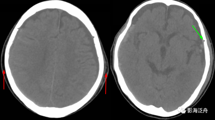 颅骨骨折(上)_医学界-助力医生临床决策和职业成长