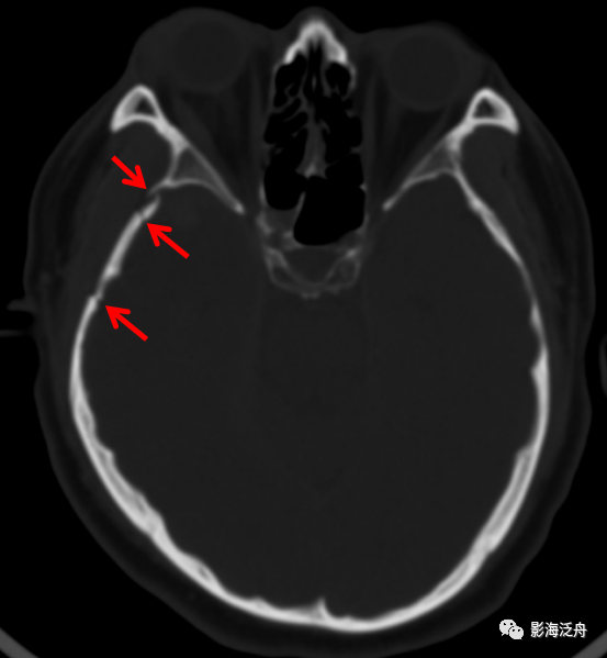 病例9:颞骨(鳞部)骨质薄弱,无法实现力的传导,较容易发生骨折并在受力