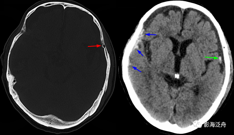 颅骨骨折(上)_医学界-助力医生临床决策和职业成长
