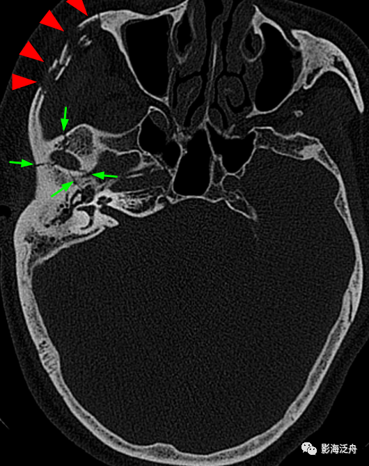 右侧颧弓骨折(红箭),注意对照前文的解剖标注图里的标注区2,颞骨与