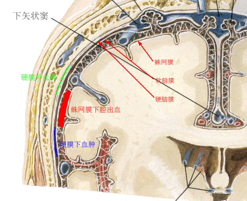硬膜下血肿主要是静脉窦的分支静脉(桥静脉)破裂引起.