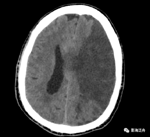 夜班不再求人:急性脑梗死ct诊断_医学界-助力医生临床决策和职业成长