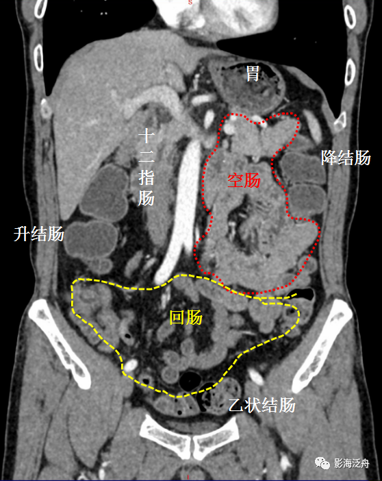 小肠ct分段解剖图图片