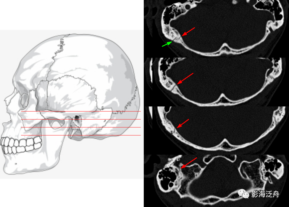 颅骨骨折(下)_医学界-助力医生临床决策和职业成长