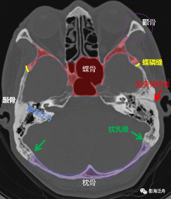 颅骨骨折(下)_医学界-助力医生临床决策和职业成长