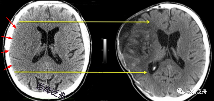 夜班不再求人:急性腦梗死ct診斷_醫學界-助力醫生臨床決策和職業成長