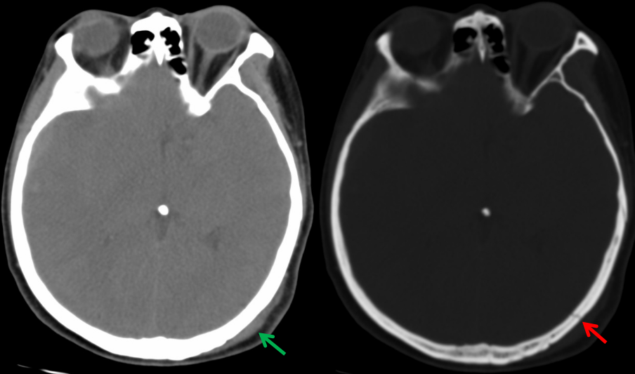 颅骨骨折(上)_医学界-助力医生临床决策和职业成长