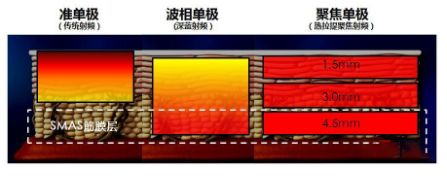 多极射频是什么RF射频到底是什么？_https://www.jmylbn.com_新闻资讯_第2张
