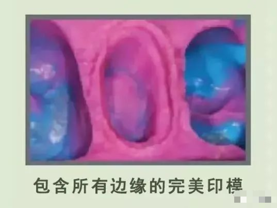 牙科材料硅胶怎么用【干货】简便式完美取模技巧（附牙体制备后双线排龈、硅橡胶取模实拍视频）_https://www.jmylbn.com_新闻资讯_第13张