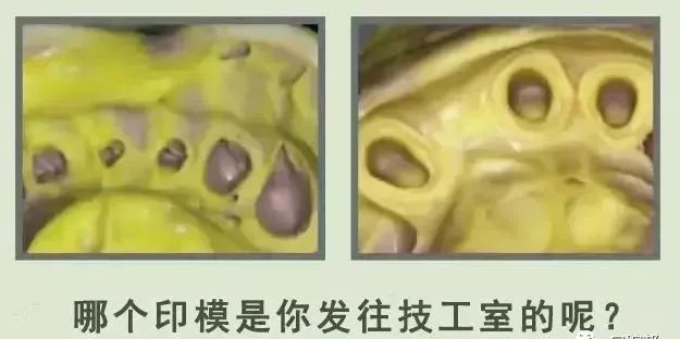 牙科材料硅胶怎么用【干货】简便式完美取模技巧（附牙体制备后双线排龈、硅橡胶取模实拍视频）_https://www.jmylbn.com_新闻资讯_第4张
