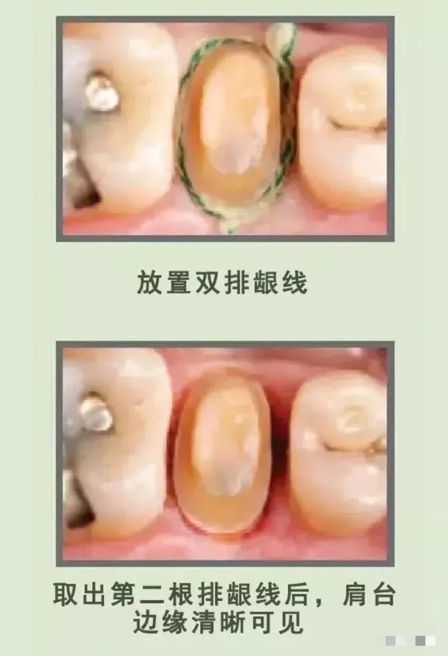 牙科材料硅胶怎么用【干货】简便式完美取模技巧（附牙体制备后双线排龈、硅橡胶取模实拍视频）_https://www.jmylbn.com_新闻资讯_第10张