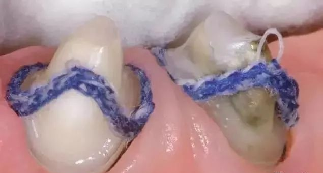 牙科材料硅胶怎么用【干货】简便式完美取模技巧（附牙体制备后双线排龈、硅橡胶取模实拍视频）_https://www.jmylbn.com_新闻资讯_第8张