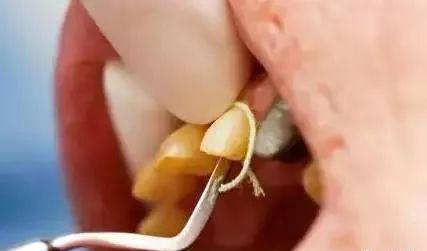 牙科材料硅胶怎么用【干货】简便式完美取模技巧（附牙体制备后双线排龈、硅橡胶取模实拍视频）_https://www.jmylbn.com_新闻资讯_第6张