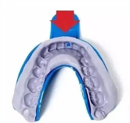 牙科材料硅胶怎么用【干货】简便式完美取模技巧（附牙体制备后双线排龈、硅橡胶取模实拍视频）_https://www.jmylbn.com_新闻资讯_第3张