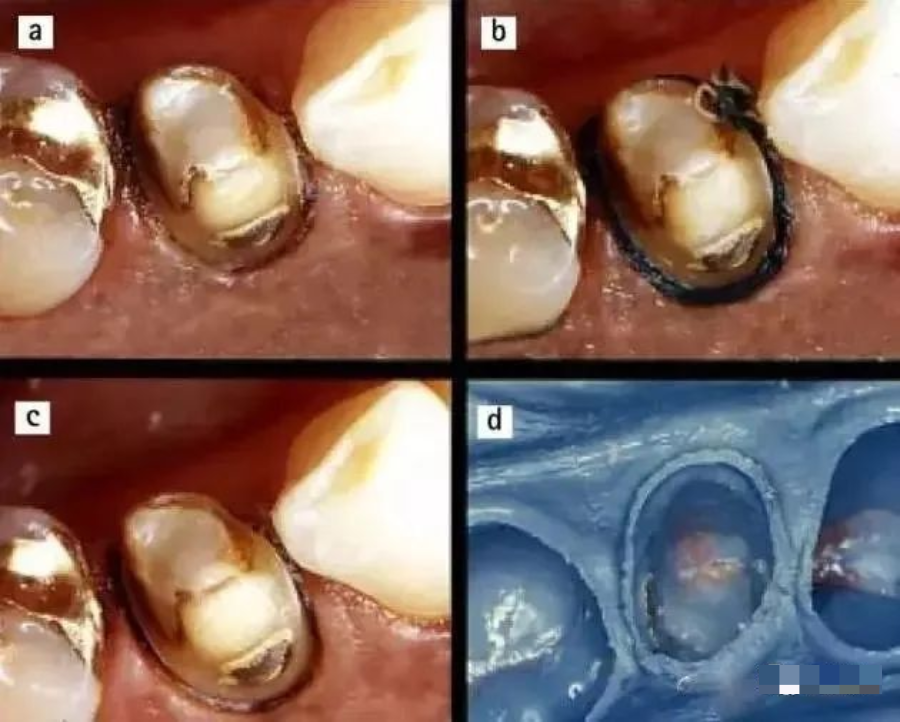 牙科材料硅胶怎么用【干货】简便式完美取模技巧（附牙体制备后双线排龈、硅橡胶取模实拍视频）_https://www.jmylbn.com_新闻资讯_第9张