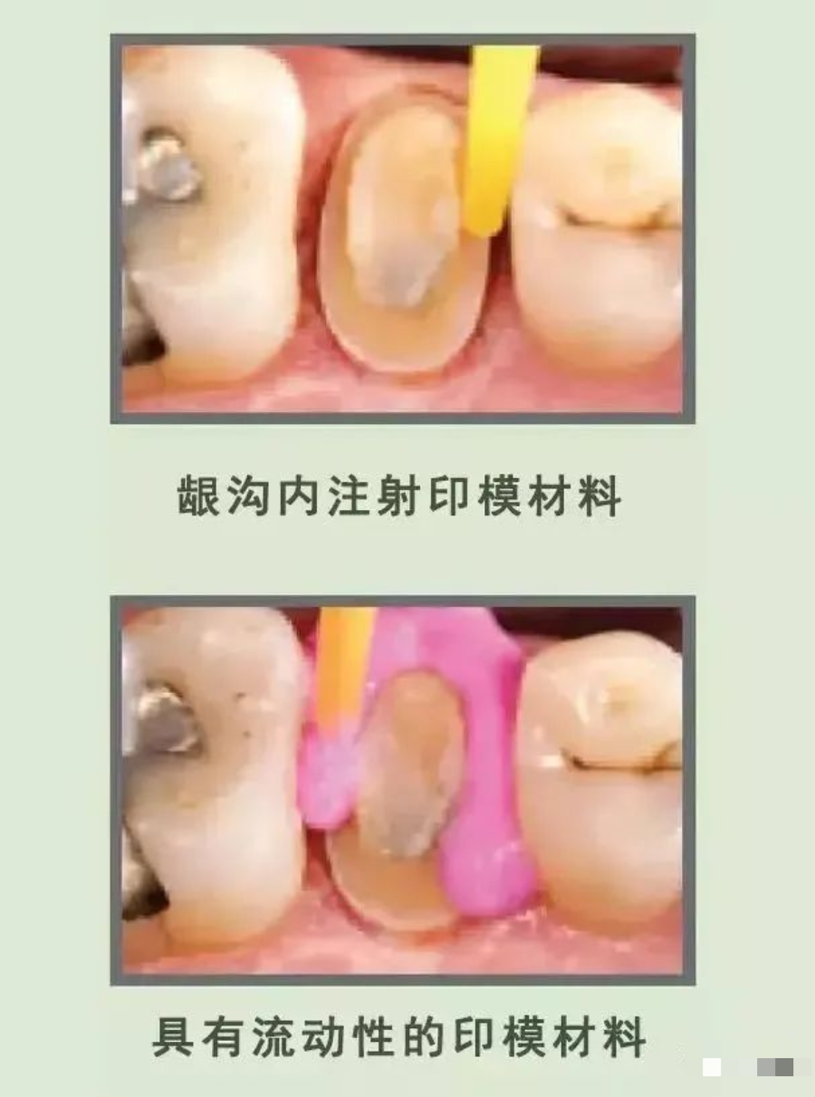 牙科材料硅胶怎么用【干货】简便式完美取模技巧（附牙体制备后双线排龈、硅橡胶取模实拍视频）_https://www.jmylbn.com_新闻资讯_第11张