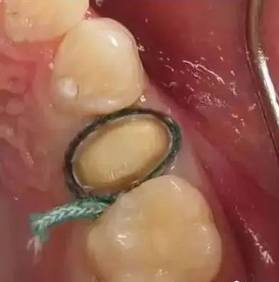 牙科材料硅胶怎么用【干货】简便式完美取模技巧（附牙体制备后双线排龈、硅橡胶取模实拍视频）_https://www.jmylbn.com_新闻资讯_第5张