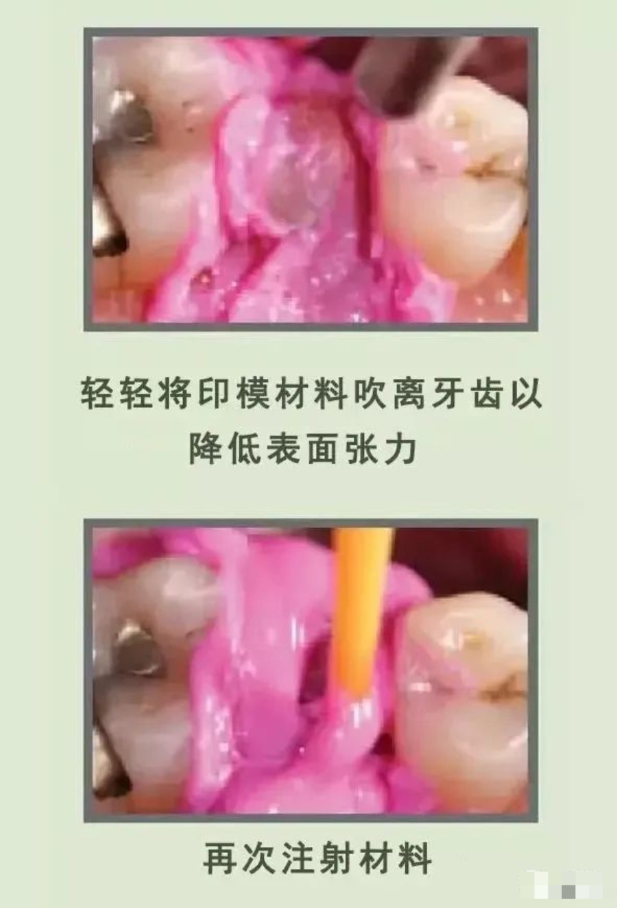 牙科材料硅胶怎么用【干货】简便式完美取模技巧（附牙体制备后双线排龈、硅橡胶取模实拍视频）_https://www.jmylbn.com_新闻资讯_第12张