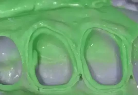 牙科材料硅胶怎么用【干货】简便式完美取模技巧（附牙体制备后双线排龈、硅橡胶取模实拍视频）_https://www.jmylbn.com_新闻资讯_第7张