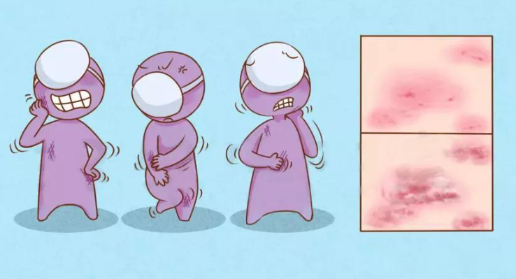 得了头皮溢脂性皮炎该怎么办？