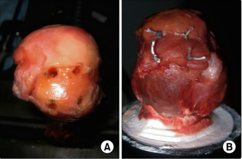 为什么会有单关节器械关节镜下肩袖修复：单排 vs 双排缝合，如何选择？_https://www.jmylbn.com_新闻资讯_第8张