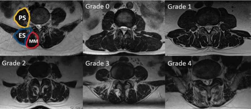 为什么会有单关节器械关节镜下肩袖修复：单排 vs 双排缝合，如何选择？_https://www.jmylbn.com_新闻资讯_第5张