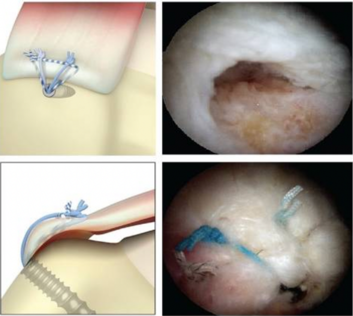 为什么会有单关节器械关节镜下肩袖修复：单排 vs 双排缝合，如何选择？_https://www.jmylbn.com_新闻资讯_第12张
