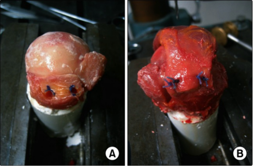 为什么会有单关节器械关节镜下肩袖修复：单排 vs 双排缝合，如何选择？_https://www.jmylbn.com_新闻资讯_第7张