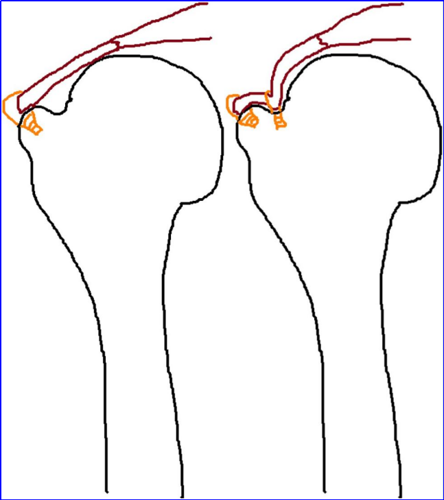 为什么会有单关节器械关节镜下肩袖修复：单排 vs 双排缝合，如何选择？_https://www.jmylbn.com_新闻资讯_第3张