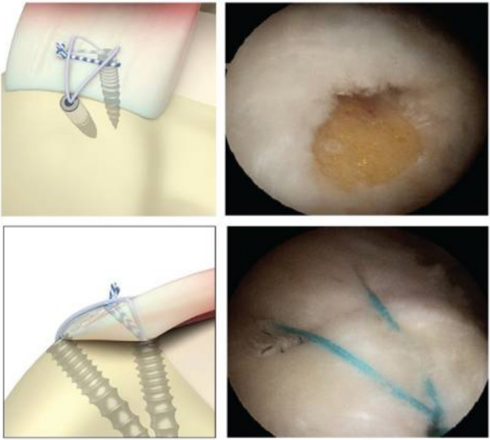 为什么会有单关节器械关节镜下肩袖修复：单排 vs 双排缝合，如何选择？_https://www.jmylbn.com_新闻资讯_第13张