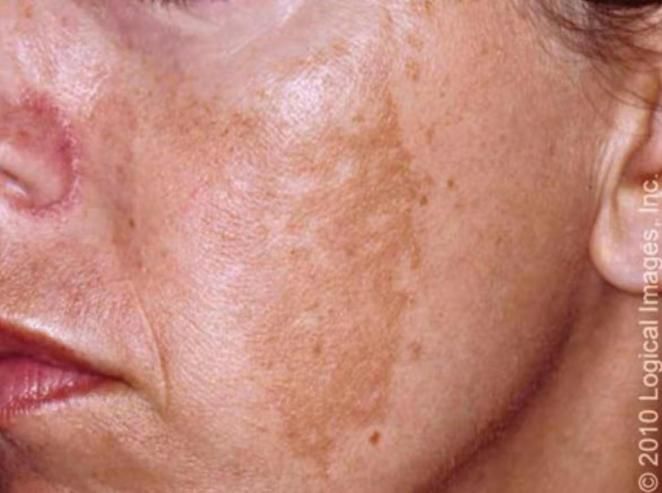 黄褐斑,咖啡斑,痘印.脸上的这些印迹怎么处理?