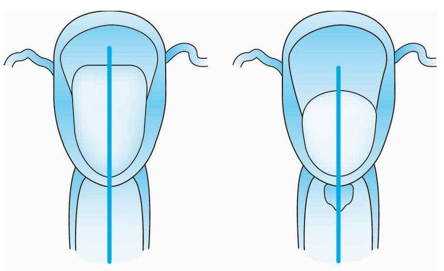 怎么放置子宫球囊支架妇产科必备技能！产后出血的6大手术治疗方式_https://www.jmylbn.com_新闻资讯_第4张