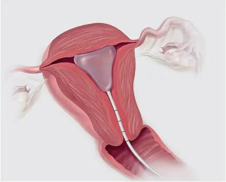 子宫球囊支架怎么取产后“止血神器” ｜ 球囊子宫支架_https://www.jmylbn.com_新闻资讯_第2张