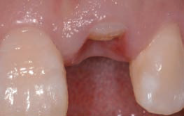 单颗前牙即刻种植即刻修复美学缺陷分析