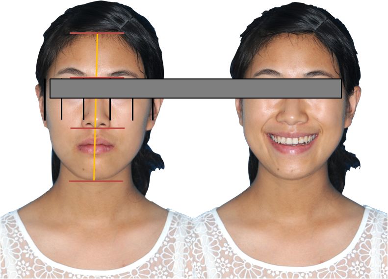 拔除第一磨牙矫治开合