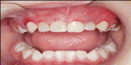 儿童乳牙预成冠详细讲解