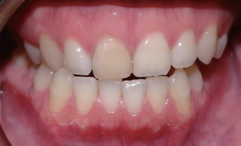 牙胶尖什么颜色MTA的临床应用——陈志平教授_https://www.jmylbn.com_新闻资讯_第1张