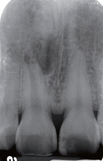 牙胶尖什么颜色MTA的临床应用——陈志平教授_https://www.jmylbn.com_新闻资讯_第3张