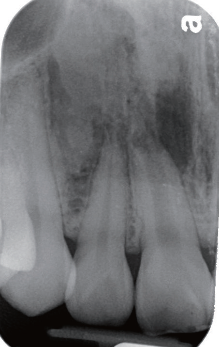 牙胶尖什么颜色MTA的临床应用——陈志平教授_https://www.jmylbn.com_新闻资讯_第2张
