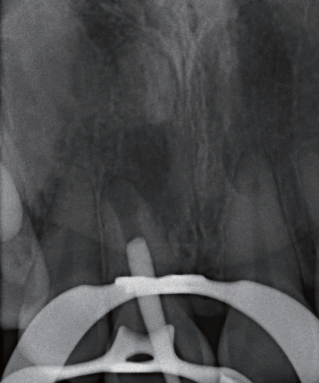 牙胶尖什么颜色MTA的临床应用——陈志平教授_https://www.jmylbn.com_新闻资讯_第10张