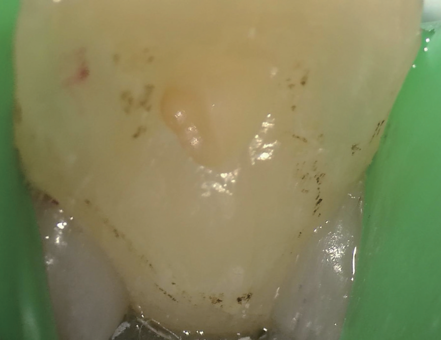 牙胶尖什么颜色MTA的临床应用——陈志平教授_https://www.jmylbn.com_新闻资讯_第6张