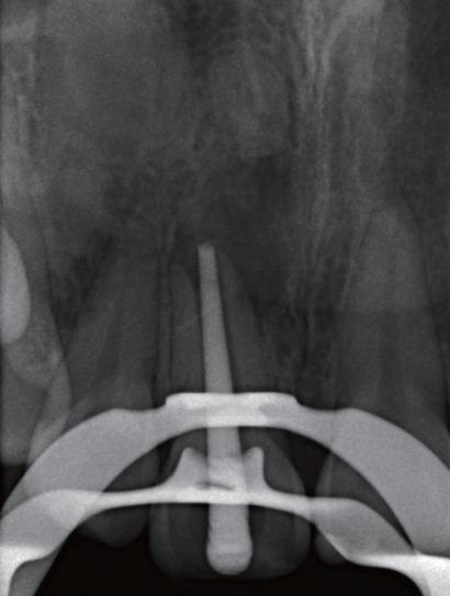 牙胶尖什么颜色MTA的临床应用——陈志平教授_https://www.jmylbn.com_新闻资讯_第9张